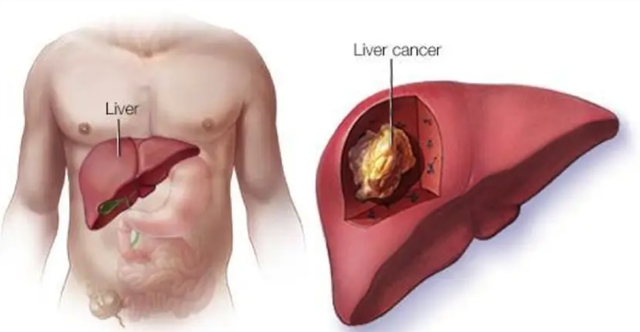 【關(guān)注】男子患肝癌，可免費(fèi)治療一年！
