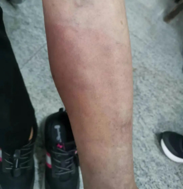 【警惕】又一批人因?yàn)榕菽_進(jìn)了醫(yī)院，這4種人真的不適合泡腳！