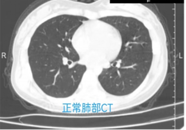 懷疑自己患上“白肺”？先看看這些才知道！