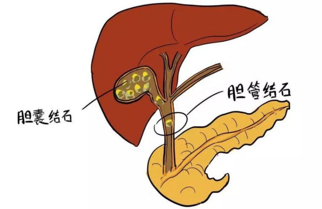【圍觀】一頓火鍋后，瀘州孃孃要切膽囊？