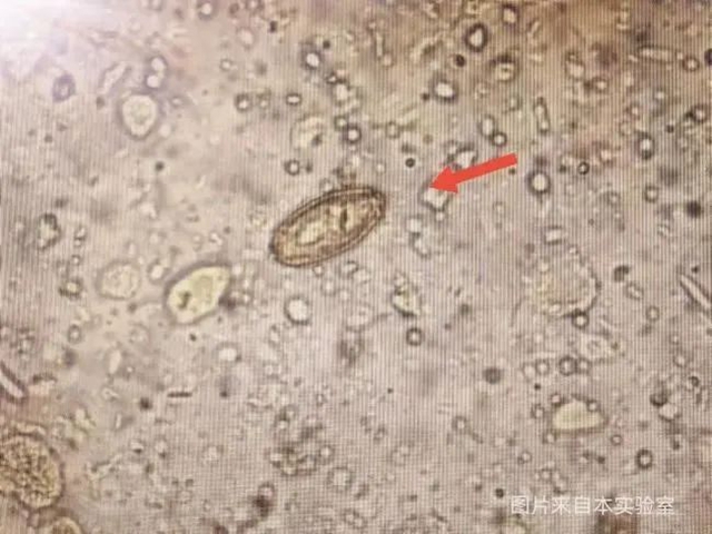 【警惕】連續(xù)幾天查出肝吸蟲卵，醫(yī)生提醒：這種食物少吃！