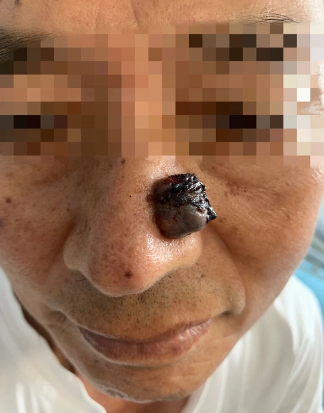 【圍觀】鼻子上的一顆痘，竟長(zhǎng)成癌中之王