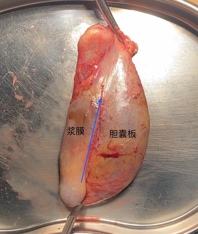 【當(dāng)心】息肉癌變！專家提醒：這樣的要及時切