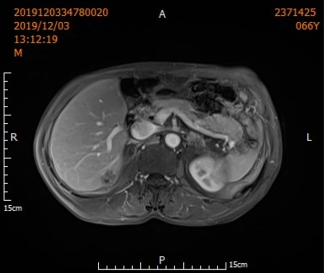 【圍觀】超低溫-160 ℃，凍死腫瘤，癌癥不用開刀了