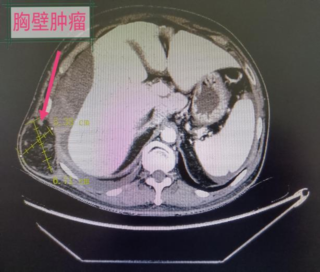 9個(gè)科室的專家集體出動(dòng)，為他取出滿滿一盆腫瘤...