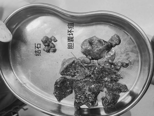 【擴(kuò)散】一頓牛油火鍋，瀘州嬢嬢膽囊遭戳脫！