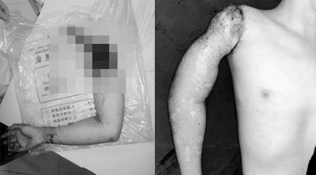 【驚險】19歲男子手臂被絞斷，流血不止.......