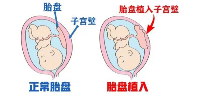 【兇險】罕見的熊貓血孕婦，出血“一灘”......