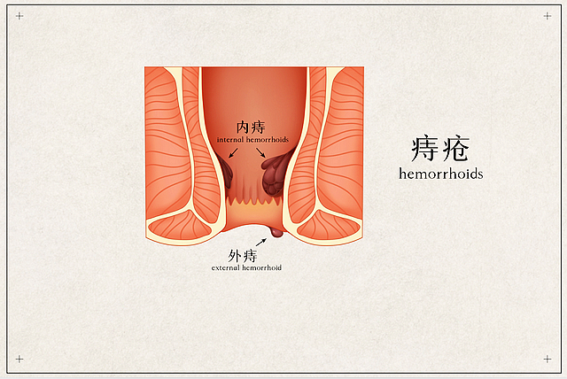 【提醒】錯(cuò)把腸癌當(dāng)痔瘡，耽誤了多少性命！大便出現(xiàn)這3個(gè)變化，要懷疑腸癌的可能