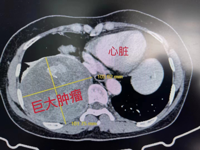 【圍觀】直徑超13厘米，女子長出巨大腫瘤！