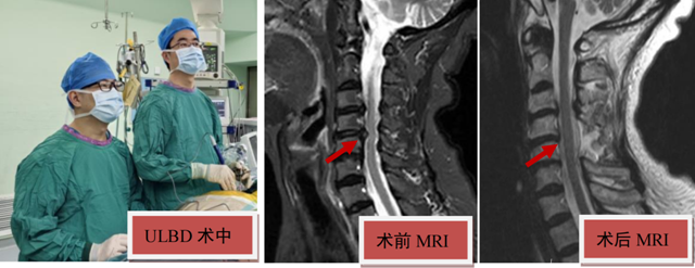 僅開直徑不足1厘米小孔做手術(shù)，就解決了75歲婆婆常年手臂疼痛困擾……