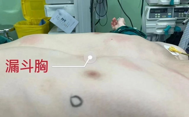 【圍觀】年僅20歲，胸卻塌了！