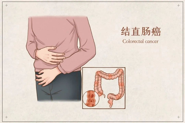 【擴(kuò)散】30歲瀘州小伙患腸癌，大便這些情況，需注意......