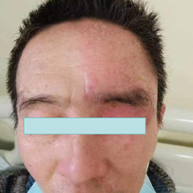 【關注】可怕的“蛇纏腰”，纏滿一圈就會死人嗎？