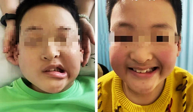 【警惕】10歲小孩面癱！