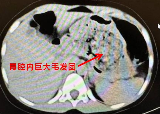 【圍觀】5歲女孩確診“長(zhǎng)發(fā)公主綜合征”？多地已有病例，醫(yī)生提醒