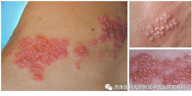 【擴(kuò)散】這個(gè)病，死不了但折磨人！這4類人要當(dāng)心