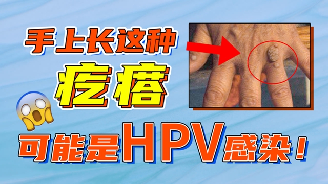【警惕】一身長疣，HPV感染惹得禍？