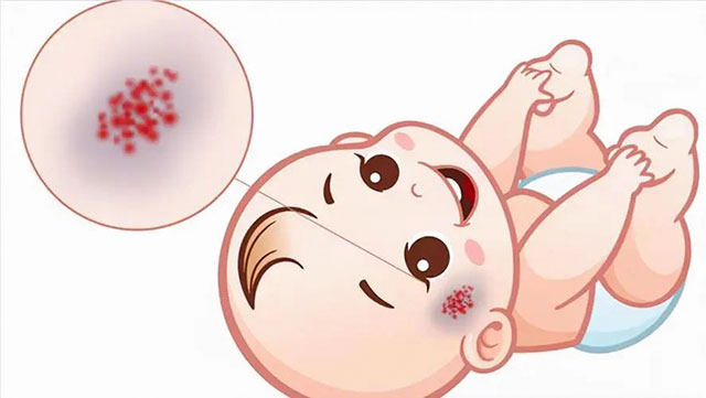 【警惕】7個月寶寶，面部長出血管瘤！