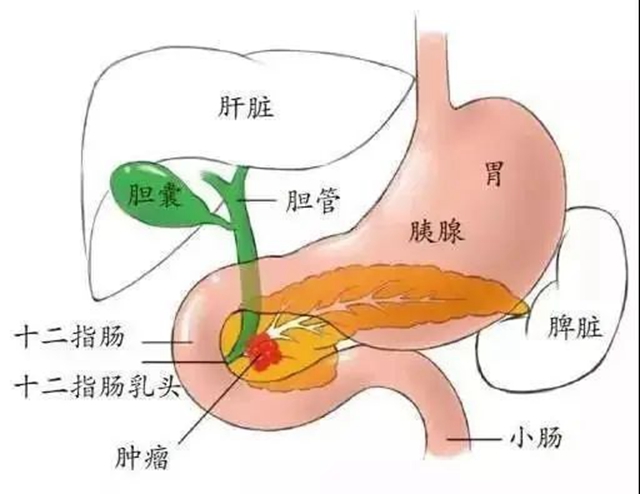 【警惕】肚子痛了半個(gè)月，一查竟是癌......