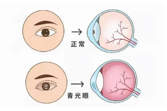 【開會啦】眼睛酸脹、看不清，小心這種致盲??！(文末學術(shù)研討別錯過）