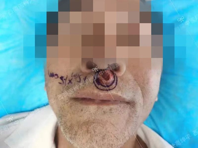 【圍觀】瀘州男子人中長(zhǎng)個(gè)“豆”，竟是癌……