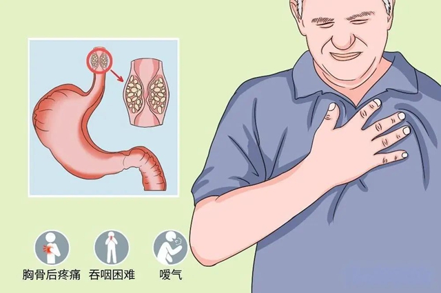 【警惕】吃東西哽起哽起的，癌！