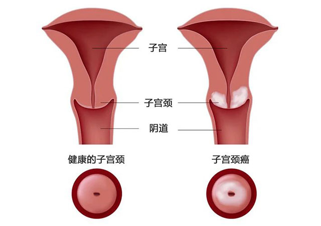 【警惕】24歲女子陰道流液，長(zhǎng)菜花狀腫塊，確診宮頸癌