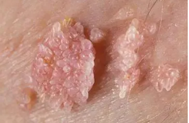 【警惕】00后情侶雙雙感染HPV，身上長(zhǎng)“花椰菜”......
