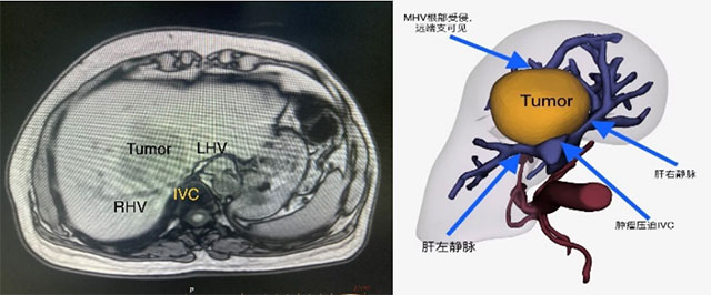 【擴(kuò)散】瀘州男子切肝?