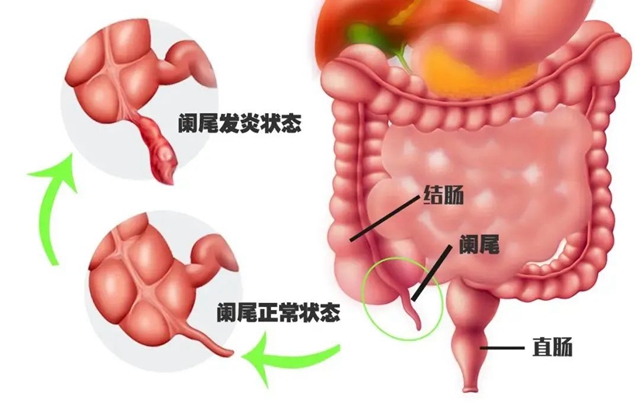 【警惕】男子吃西瓜不吐籽，掉進(jìn)闌尾，結(jié)果……