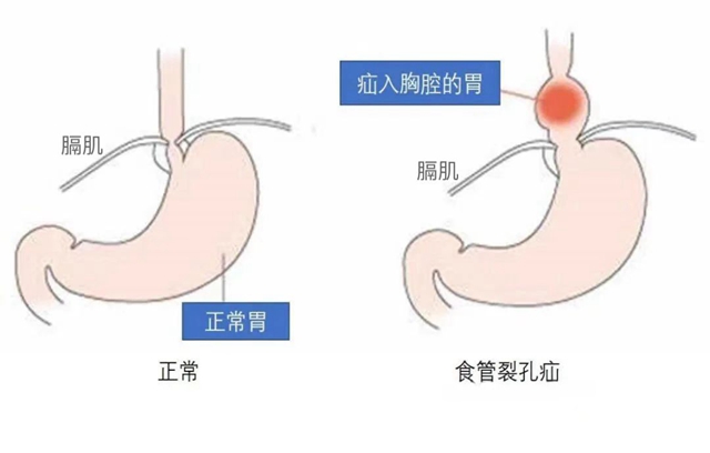 【圍觀】一吃就吐，男子胃部“竄”進(jìn)了個(gè)大洞......