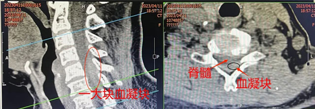 【驚呆】瀘州孃孃脖子開大刀……