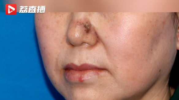 【圍觀】女子鼻子長“黑頭”，一查竟是癌......