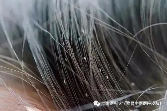 【警惕】靠吸人血為生的小“頭虱”，大麻煩！