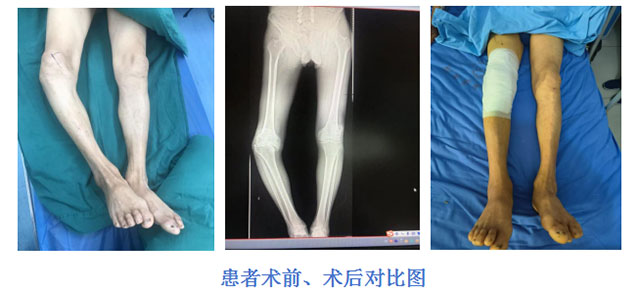【專科技術(shù)】全膝人工關(guān)節(jié)置換術(shù)，讓患者重燃行走“膝”望！