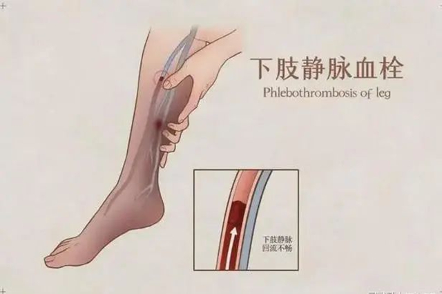 【關(guān)注】驚！置入濾器滯留男子體內(nèi)長達6年，險些……
