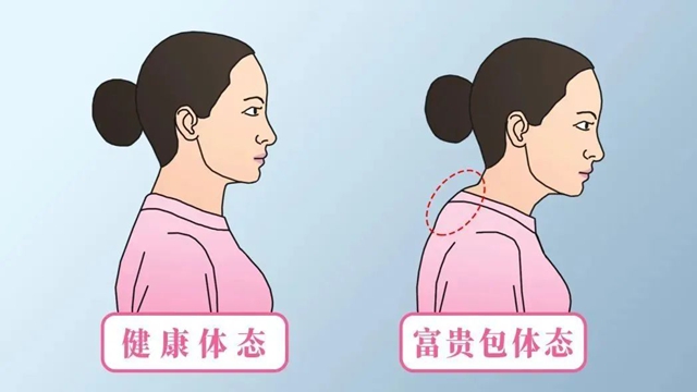【科普講堂】改善頭前傾，消除富貴包，這4個動作超級有效！