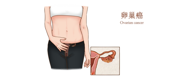 【擴(kuò)散】女子腹痛不適竟確診卵巢癌！出現(xiàn)這5個(gè)癥狀，一定要注意