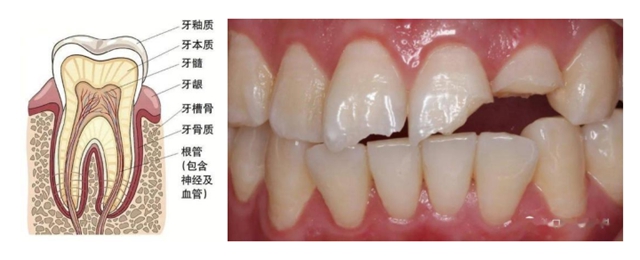 【口腔科普】守護(hù)牙齒健康，遠(yuǎn)離意外傷害！