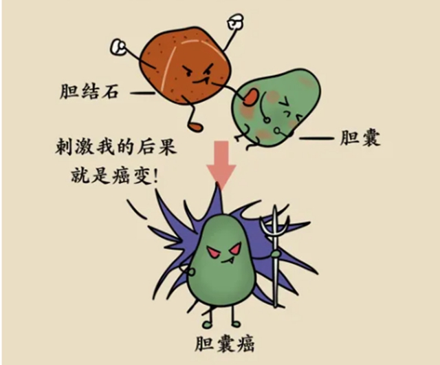 【警惕】晚飯后腹部劇痛不止，膽囊被嘎掉，有這些情況要當心！