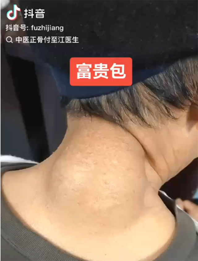 【圍觀】超大塊“富貴包”，就像往后脖頸塞了塊面包！
