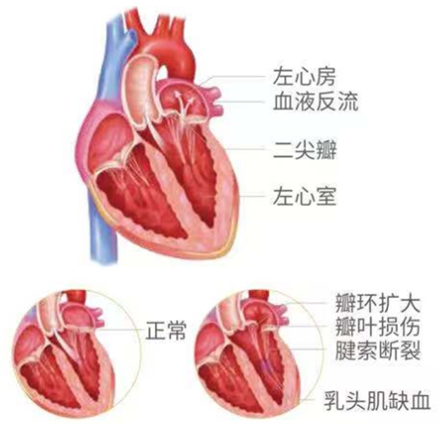【精密】血液倒起流，醫(yī)生在心尖上動(dòng)刀修復(fù)心門(mén)