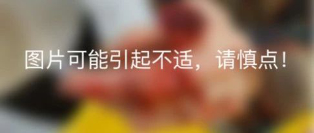 驚！一患者因故絞斷手指，竟將斷指浸泡在酒精里保存……