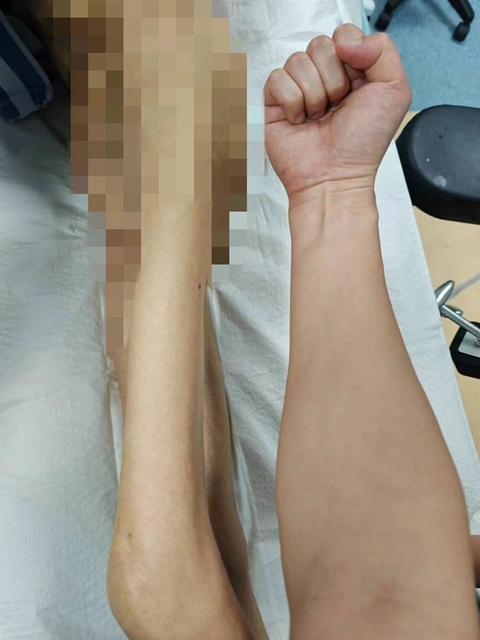 體重僅有60斤左右，瘦骨嶙峋的老人骨折了······