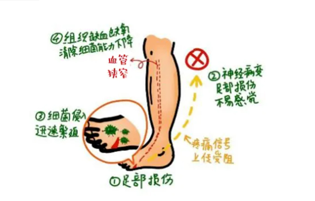 走近糖尿病足