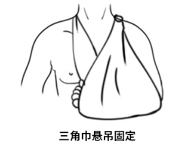 【關(guān)注】男童鎖骨摔成兩截……