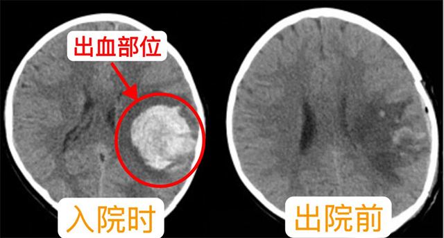 【病例分享】古藺中醫(yī)人用仁心妙術(shù)點(diǎn)亮九歲患兒的希望之光！