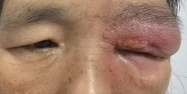 【病例分享】誤用草藥治療瞼黃瘤險毀容？科學識別與處理指南助您避坑！