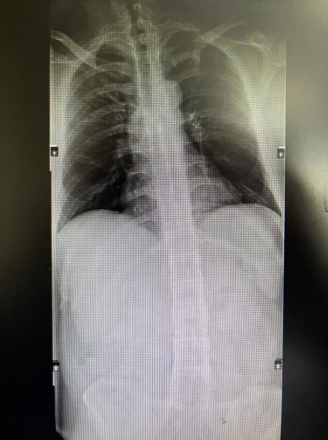 【圍觀】30歲小伙反復腰背疼痛，竟患“不死癌癥”！醫(yī)生：尚無根治方法